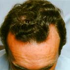 Hairmax Lasercomb