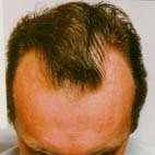 Hairmax Lasercomb