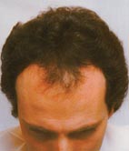 Hairmax Lasercomb