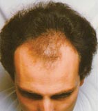 Hairmax Lasercomb