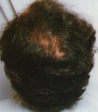 Hairmax Lasercomb